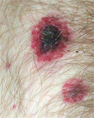 Ecthyma gangrenosum top